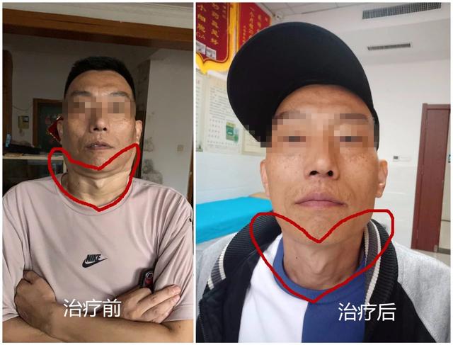 中医如何治疗淋巴瘤及其兼证？