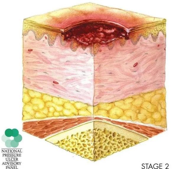 压疮情况要分期，严重危害需知道