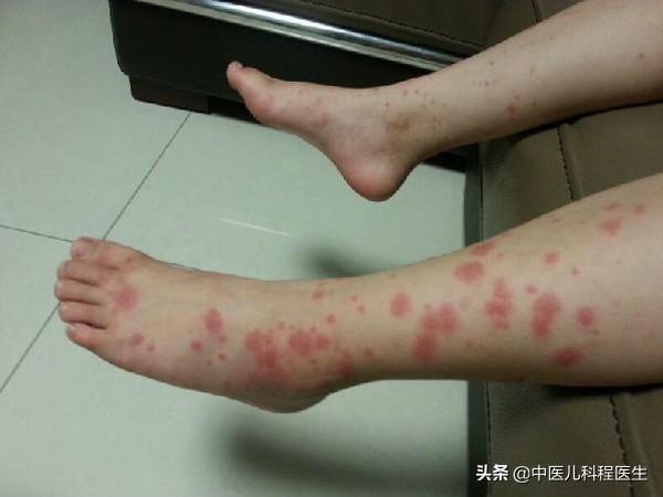 「你的育儿经」春季，宝宝的双腿突然出现很多红色的疹子，要警惕＂过敏性紫癜＂！