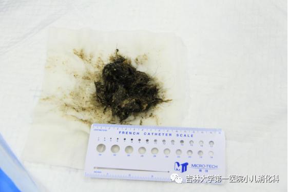 「你的育儿经」长春五岁女童自己揪这个吃，胃里巨大胃石，元凶就是它