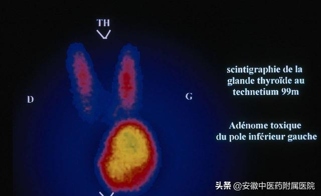 经常容易生气，小心甲状腺疾病轻易来“敲你门”