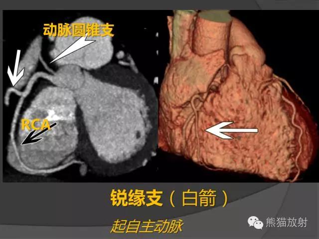 冠状动脉系统解剖、CTA解剖、分段及中英文名称对照