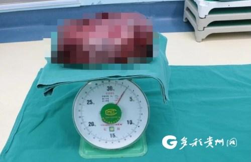 贵州省肿瘤医院妙手帮助安徽患者摘下6斤重肿瘤