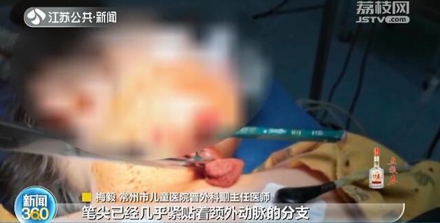 「你的育儿经」险！女童玩耍时铅笔插入脖子 离动脉仅0.01毫米
