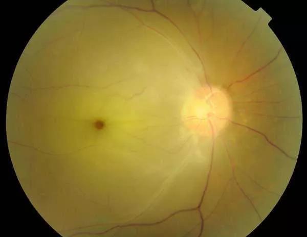 男子一觉醒来眼睛“?瞎了”，这事太可怕，很多人还在做