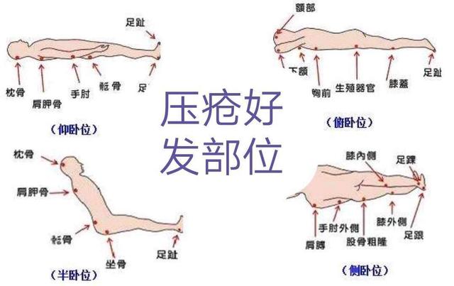 老人长期卧床，皮肤生了褥疮，怎么办？