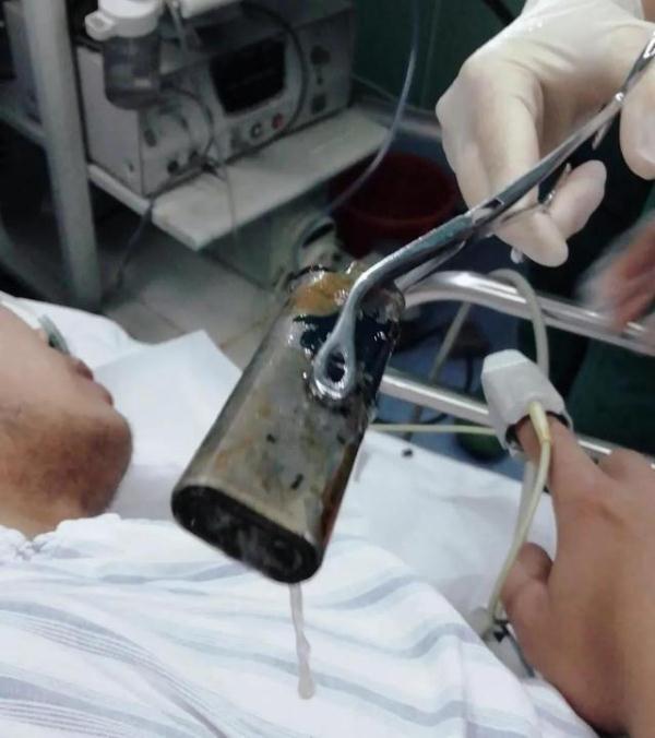 李先生|怎么做到的？东莞一男子误吞打火机近一周未取出