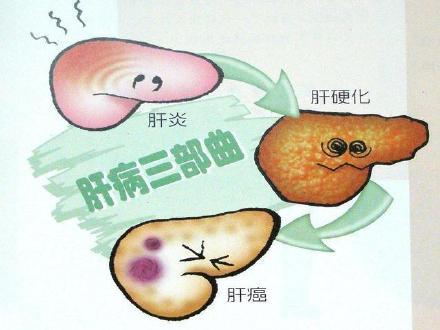 肝硬化|肝硬化患者日常生活中需要注意哪些