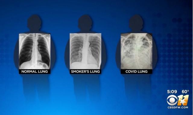 医生称COVID-19对肺部的伤害甚至比吸烟还要大