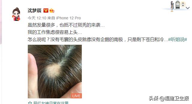 植发|沈梦辰因过度焦虑斑秃！掉发超过这数就是病！医生教你4招拯救脱发