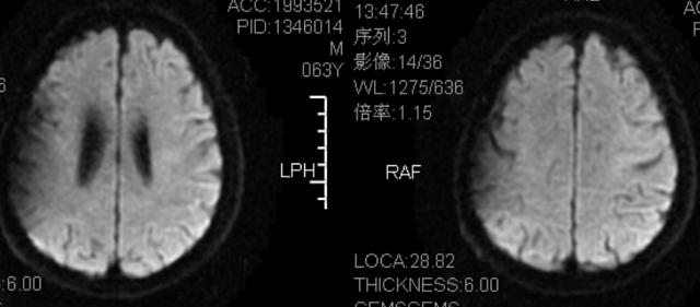 这例 DWI 高信号，不要误诊为脑梗死