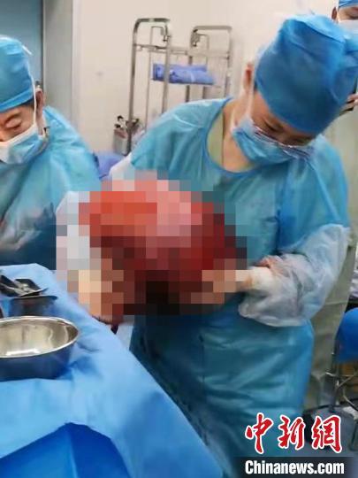肿瘤|女子“孕”态十足 医生从腹中摘除24斤巨大肿瘤
