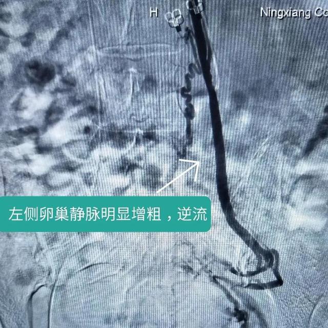 女子慢性盆腔疼痛多年，经检查竟是患了盆腔静脉淤血综合症