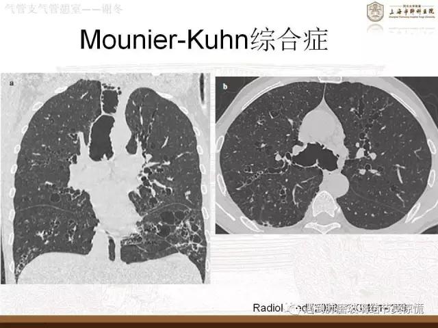 遇到气管、支气管憩室莫惊慌