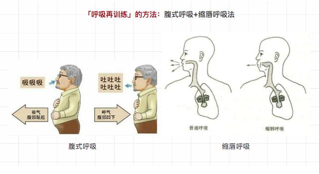 慢阻肺患者四肢细，肚子大？往往是肌肉开始萎缩