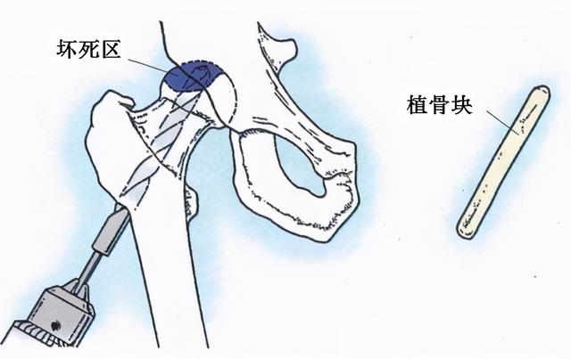 名医专访丨上海市第十人民医院郑龙坡：坏死的股骨头能否保住？