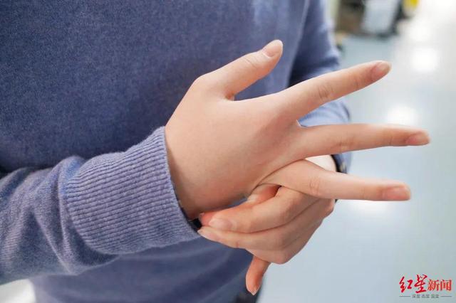 关节|成都一小伙“特异功能”手指可任意折叠！医生：这是病得小心