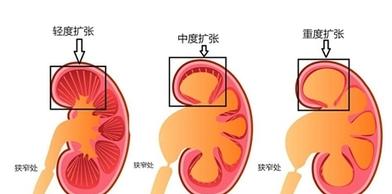 肾积水是怎么引起的？这6大诱因不可忽视！