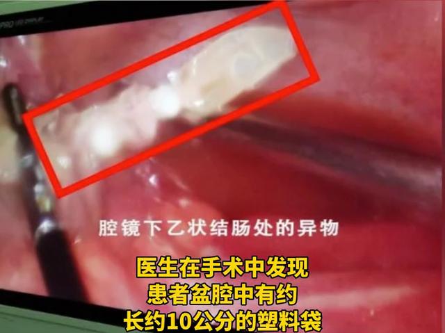 医生|男子肚里惊现塑料袋，竟是因为吃饭时的一个动作