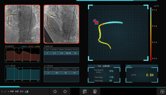要不要放支架？这个最新检测方法很“硬正”省人医在江苏率先开展