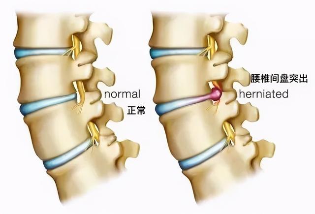 支撑|男人腰不行，一切等于零！29岁小伙子腰痛后干这事，丁丁差点废了