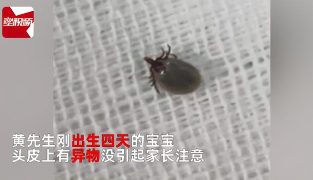 皮肤|揪心！新生儿被蜱虫钻脑！医生提醒：被叮了之后这些事不能做