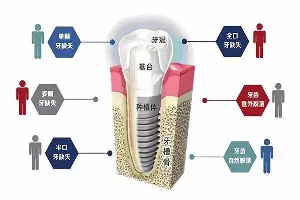 种植牙|种植牙要几次手术才能完成？具体过程是怎样的？牙科医生为你揭秘