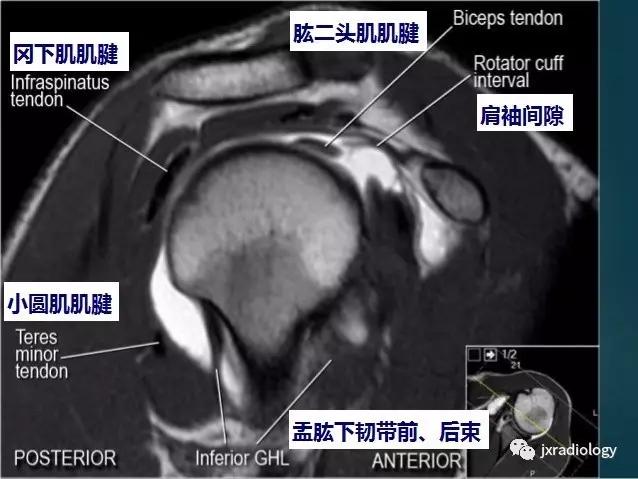 肩袖间隙的解剖及常见病变