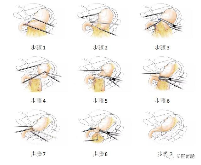 吻合|胃肠外科成功完成医院首例全腔镜远端胃癌D2根治术