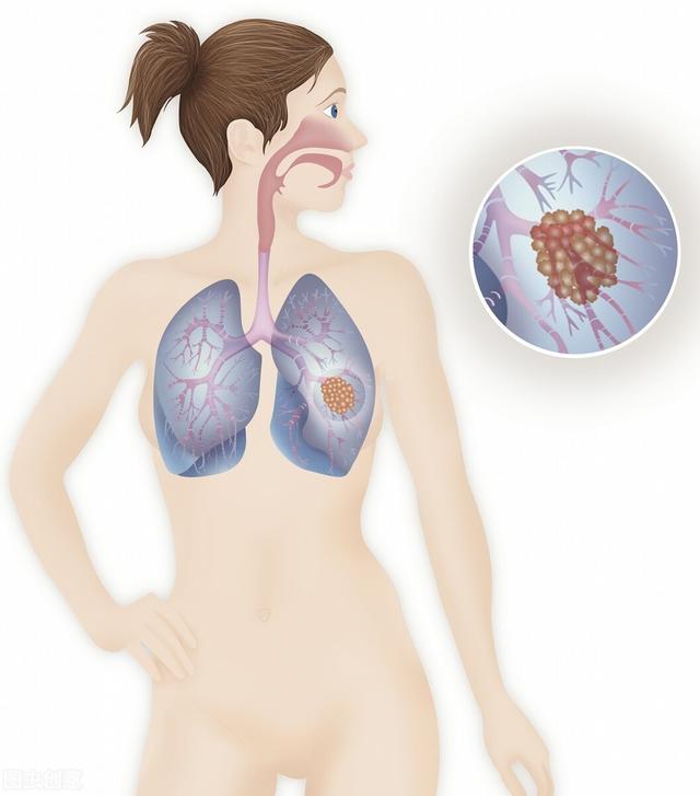 当身体出现这6种信号，警惕肺癌来袭