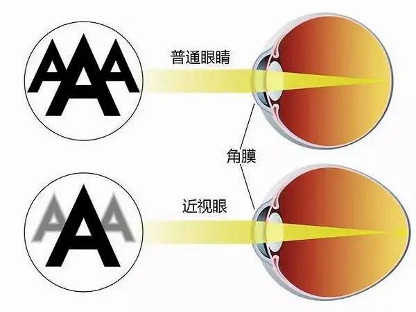 你的育儿经|近视会影响颜值？看了这些对比照，家长们后悔没有这样做