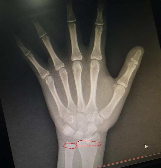 妈妈|男孩才13岁，就不再长高了！6岁弟弟也是个“小胖墩”，也要注意了