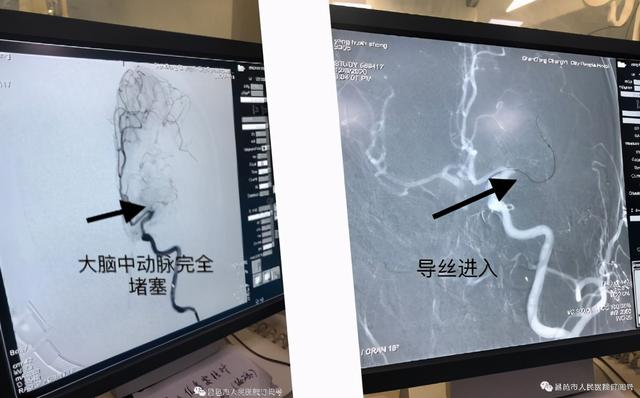 跟血栓say goodbye——昌邑市人民医院神经内二科颅内介入动脉取栓术纪实