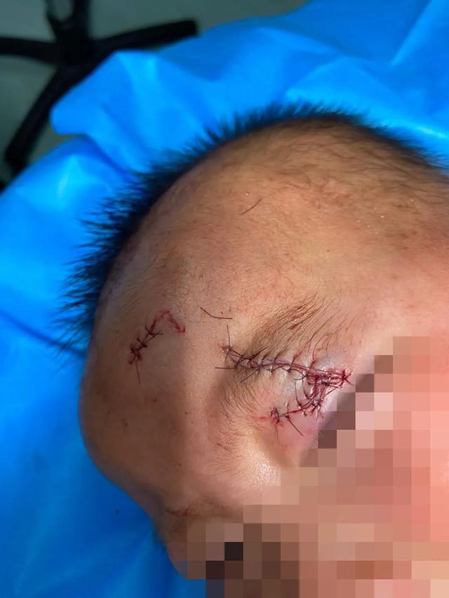 超级宝妈■2娃“耍大刀”被割伤，离眼球仅几厘米！家长注意，厨房别让孩子进