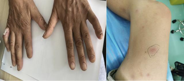 麻风病|皮肤出现这些问题要警惕！深圳16家基层