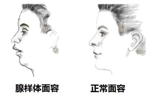 星空的浪漫|小孩子打呼噜，是扁腺问题吗？需不需要切除？
