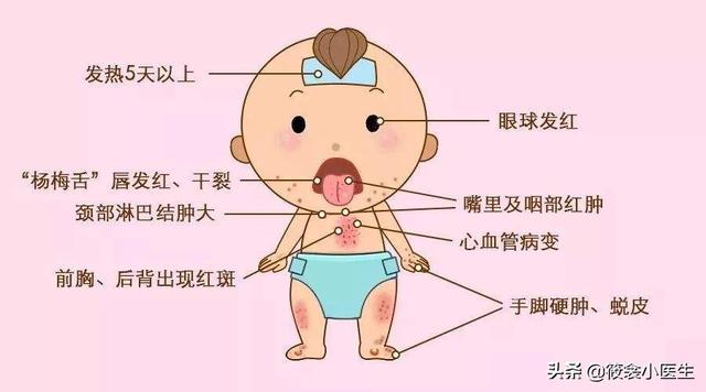 超级宝妈|跟“儿童怪病”很像的川崎病，你认识么？