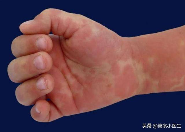 超级宝妈|跟“儿童怪病”很像的川崎病，你认识么？