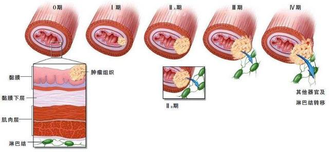 食管癌的癌前病变