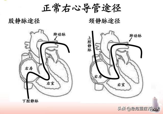 右心室|久坐也会致命？不知此病要出大问题