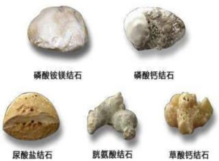 输尿管|我是肾结石，来看看我们是怎么“兴风作浪”的……