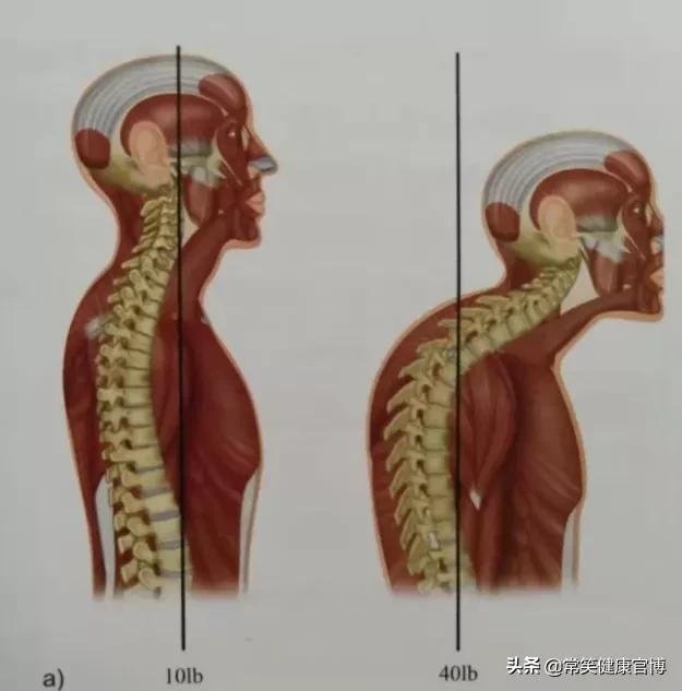 脖子后的富贵包不痛不痒，但早晚会要了你的命