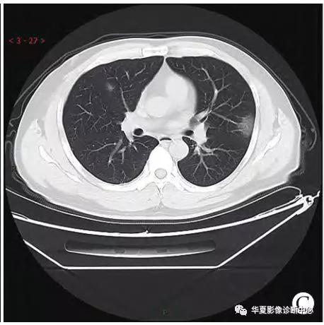 「影像进展」新冠肺炎的CT典型和不典型表现以及影像学分期