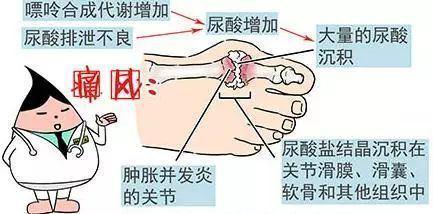 痛风|高尿酸与痛风人群的健康生活方式 有需要的可以看看