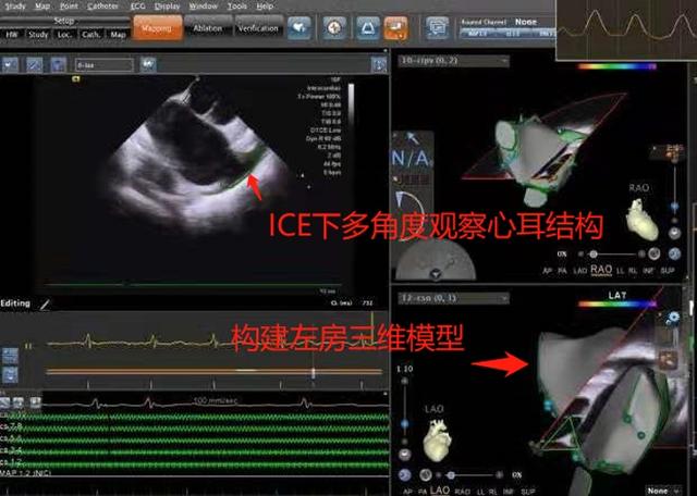 手术|普陀区中心医院开展首例心腔内超声指导下一站式治疗房颤手术