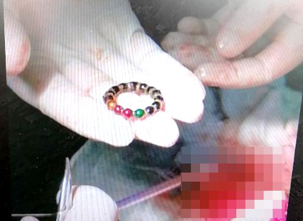 【超级宝妈】惊险！临沂2岁女童误吞15颗磁力珠受尽折磨……