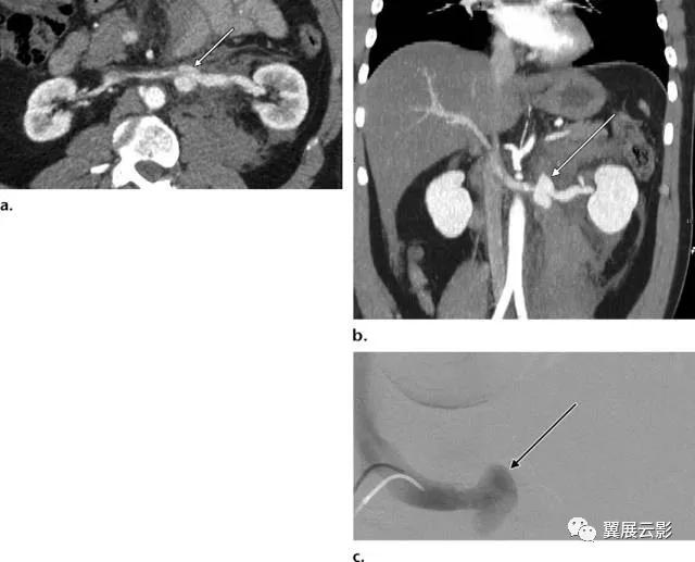 24张图汇总「肾血管」常见病变的影像学表现