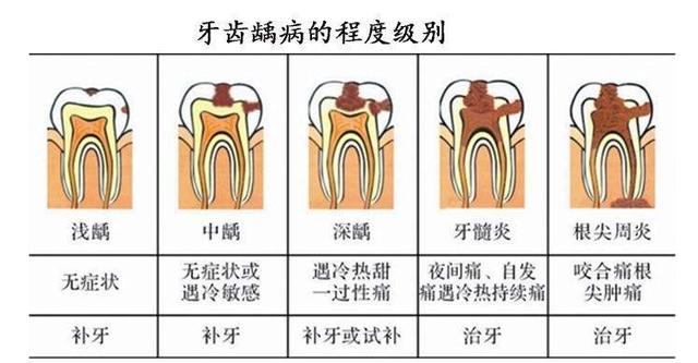 牙疼，不能着急吃止疼药，先得找准病因！有些牙疼只能杀神经