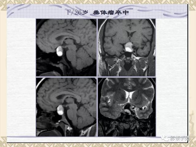 垂体病变的MRI诊断