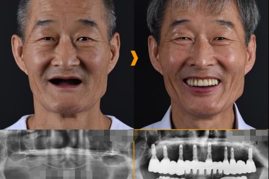 牙齿6颗缺失4颗松动，伴随严重牙周炎，王先生：我该怎么修复？